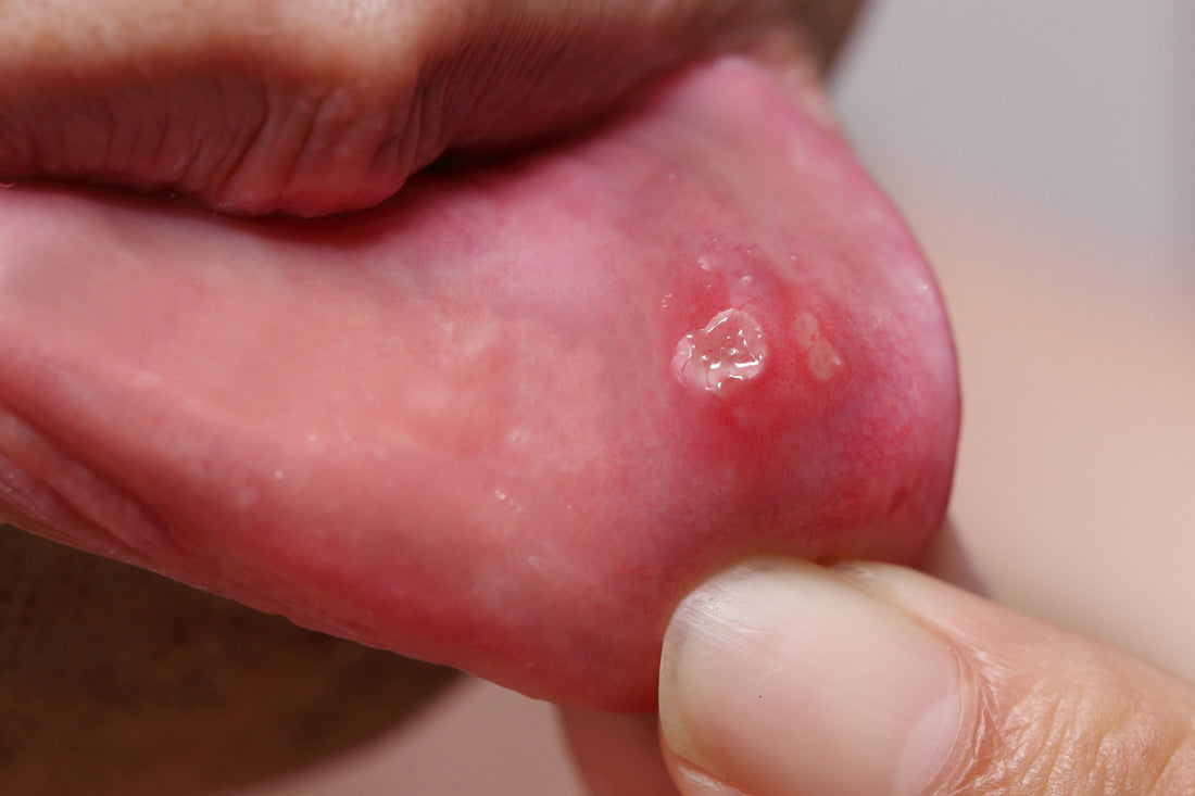 Canker Sore Pictures, Causes, & Treatment