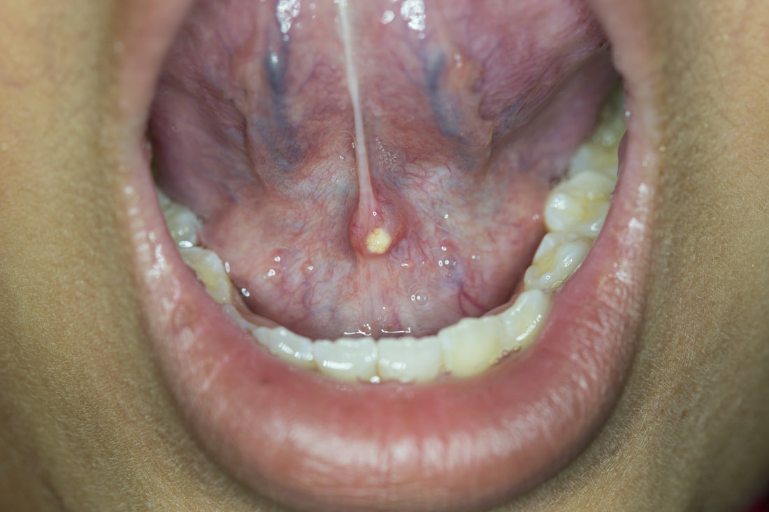 Salivary stones - How to detect, treat, and prevent