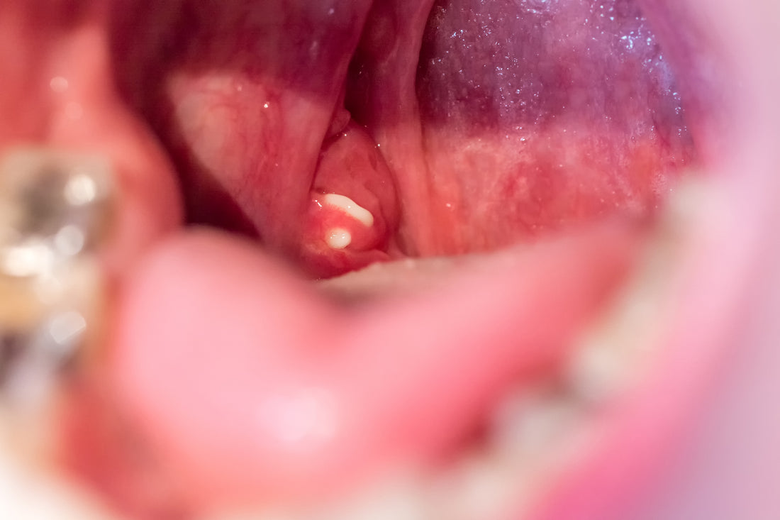 Post Nasal Drip, Bad Breath, & Tonsil Stones