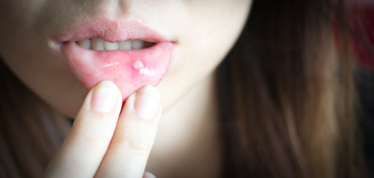 Canker Sore Symptoms, Causes, Solutions, And More