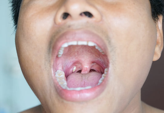 Tonsil Stone Guide | Symptoms, Causes, & Removal