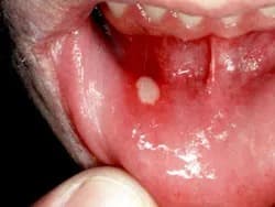 canker sore on upper gum